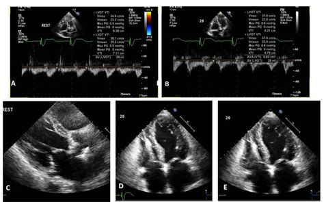 Low Flow Low Gradient Aortic Stenosis Review Signal Site Gallery Of