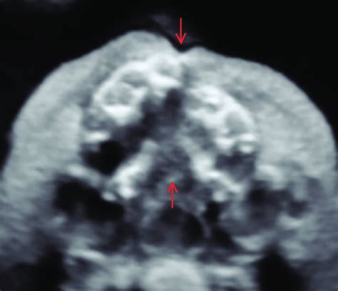 Three Dimensional Ultrasound Of Cleft Lip And Palate Arrows At 29