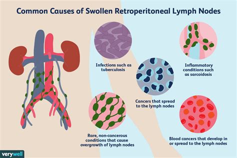 Enlarged Retroperitoneal Lymph Nodes Causes And More