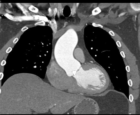 Bicuspid Aortic Valve With Calcification And Aortic Stenosis Cardiac
