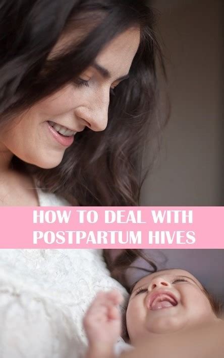 8 Easy Home Remedies To Help Every Mom Deal With Postpartum Hives