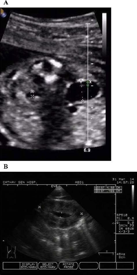 Representative Figures Of A Prenatal Fetal Ultrasound Showing A