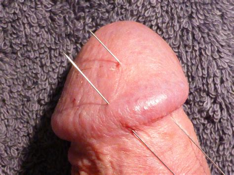 Cbt Acupuncture Needles