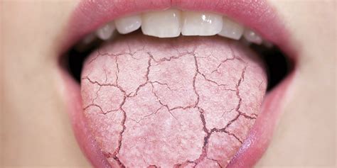 How Does Dry Mouth Affect Your Oral And Overall Body Health