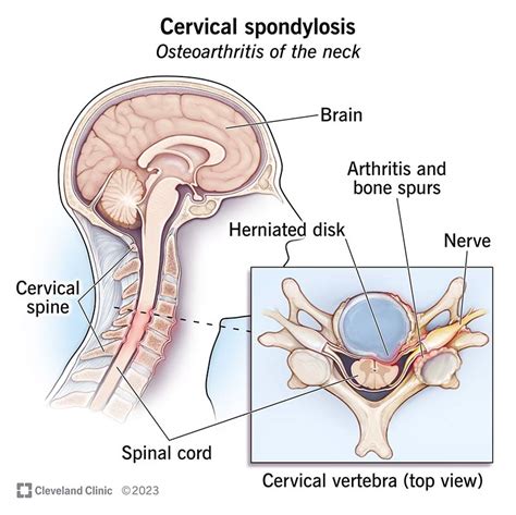 Cervical Spondylosis Symptoms Risk Factors Diagnosis And Treatment