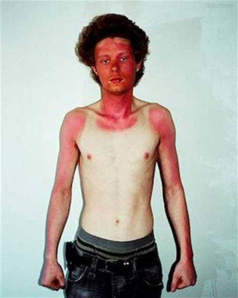 The 12 Worst Sunburns In History