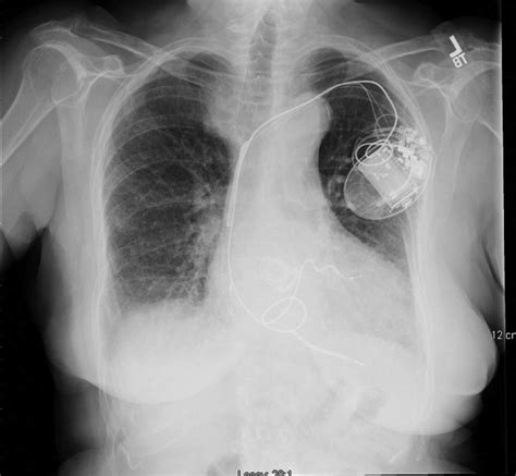 Chest X Ray Indicates Biventricular Icddual Chamber Pacemaker Arrow