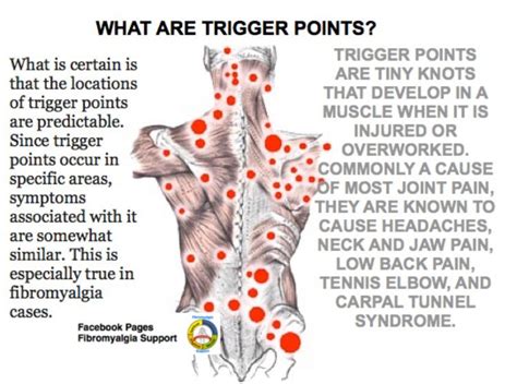 Fibromyalgia Trigger Points Fibromyalgia Chronic Migraines