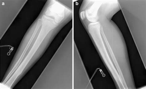 Titanium Elastic Nails For Pediatric Tibial Shaft Fractures Wudbhav N
