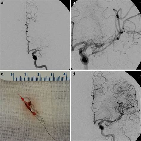 A Initial Angiogram Of The Left Middle Cerebral Artery B Temporary