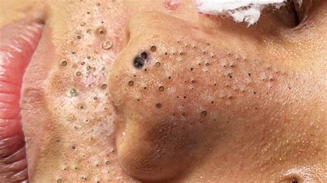 Big Cystic Acne Blackheads Extraction Blackheads And Milia Whiteheads