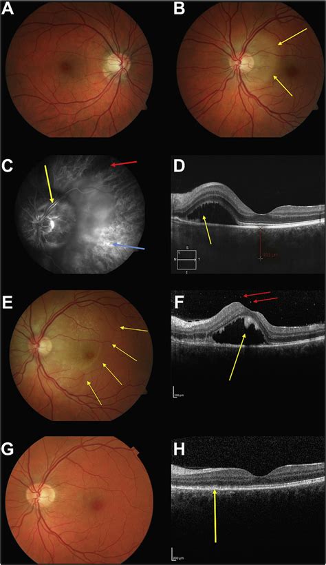 A Reactive Peripapillary Atrophy And Pigmentary Alteration In The