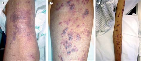 Distinctly Different Purpura On Different Arms The Lancet
