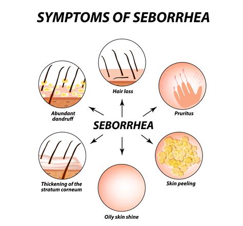 Seborrheic Dermatitis And Hair Loss Symptoms Causes And Treatment