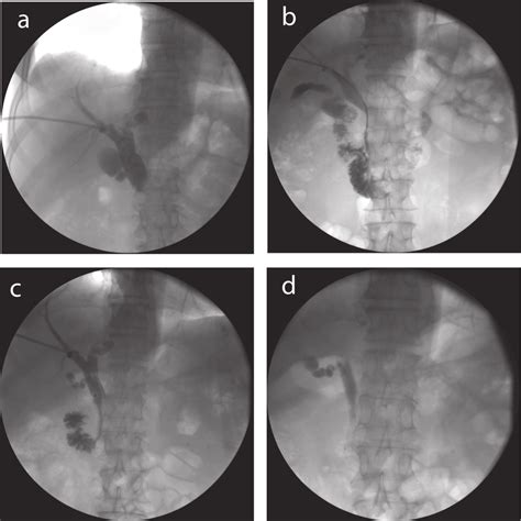 Stent Placement In A Patient With Common Bile Duct Obstruction With