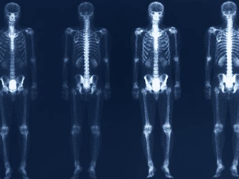 Understanding Bone Scans In Santa Fe What You Need To Know