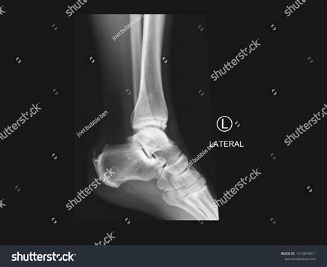 Film Xray Lateral Ankle Radiograph Showing Stock Photo 1412874017