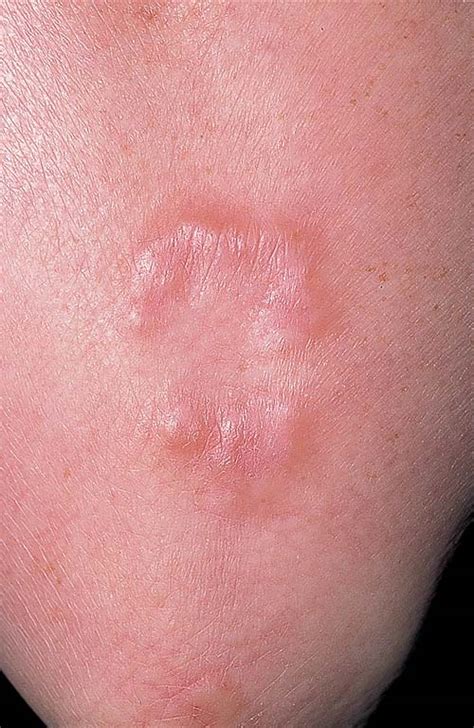 Granuloma Annulare Causes Symptoms Treatment Pictures Diagnosis