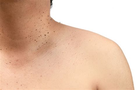 Closed Up The Skin Tags Or Seborrheic Keratosis On Neck Premium Photo