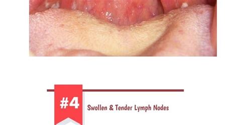 Ultimate Guide To Combat Warning Signs Of Strep Throat Strep Throat Warning Signs And Sore Throat