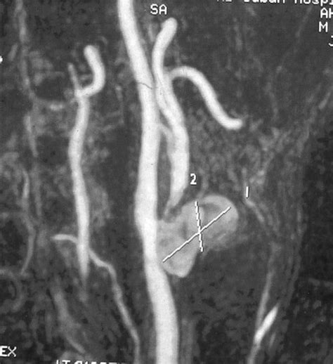 Case 2 Preoperative Contrast Enhanced Magnetic Resonance Angiogram Of