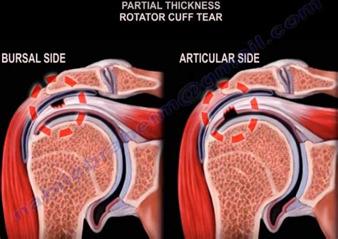 Rotator Cuff Tear Classification —