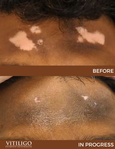 Vitiligo Before And After Treatment Vitiligo Clinics Australia