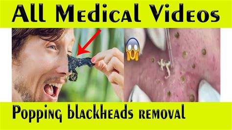 Popping Blackheads Removal Popping Blackheads Treatment Extraction