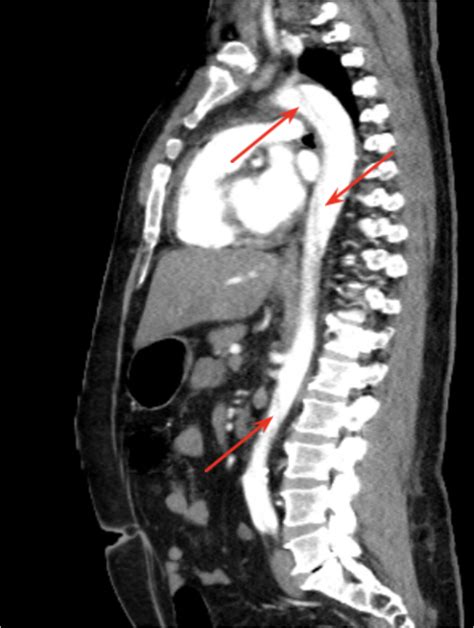 Figure 4 Cta Showing A Type A Aortic Dissection Extending Along The