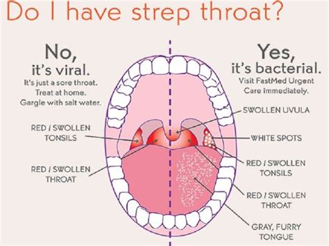 What Is Strep Throat Symptoms Causes Treatments Diagnose Prevent