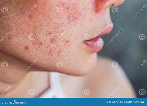 Acne On Woman`s Face With Rash Skin Scar And Spot That Allergic To
