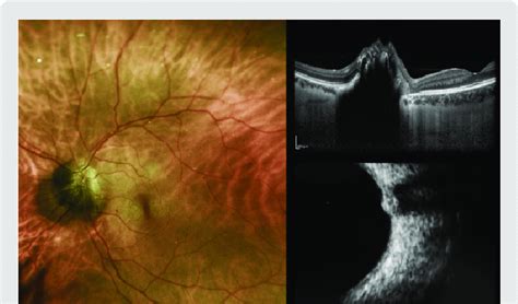 Fundus Photography Left Edi Oct And Us Imaging Bottom Right Of