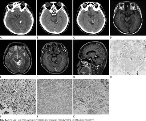 Figure 1 From Extra Axial Intracranial Ependymoma Ambient Cistern