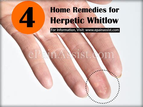 Herpetic Whitlow Or Whitlow Fingerrecoverypreventionhome Remedies
