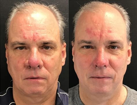 Dermabrasion Before And After Fairfax And Washington Dc