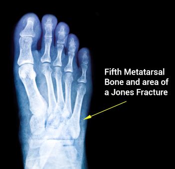 Related online courses on physioplus. Jones Fracture: Symptoms, Causes, Treatments Surgery and ...