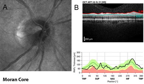 Moran Core Case Report Of Non Arteritic Ischemic Optic Neuropathy Naion