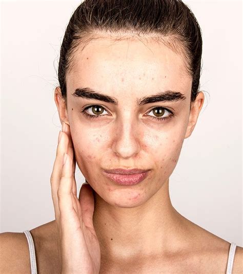Acne Face Map What Your Breakouts Are Trying To Tell You Artofit