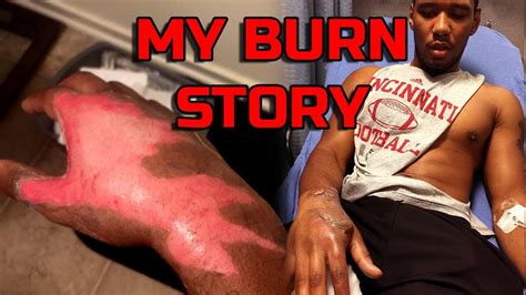 If a 2 degree thermal burn was obtained in nature and the soil (chips, particles of asphalt and other foreign bodies) got into the wound, you should immediately nevertheless, correct actions after skin lesion and competent treatment reduce the risk of scarring to zero. My Burn Story | 2nd/3rd Degree Hand Burn - YouTube