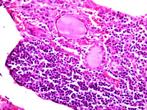 Pathology Outlines Follicular Carcinoma