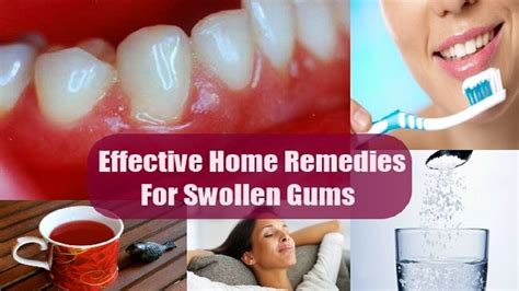 5 Home Remedies For Swollen Gums And Pain By Top 5 Youtube