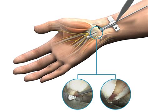 Treating Carpal Tunnel Syndrome Outside The Or Shortens Procedure And