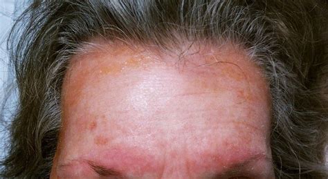 Dermatitis Around The Eyes And Mouth