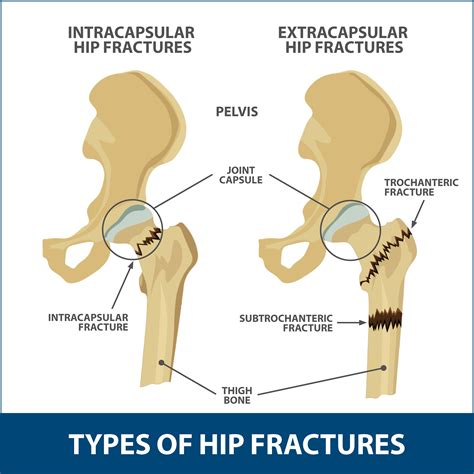 Clinical Signs Of Hip Fracture
