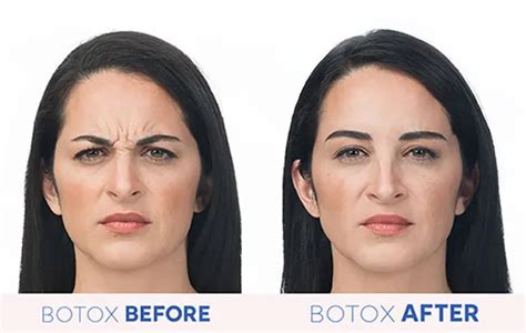 How Botox And Fillers Work To Reduce Wrinkles Victory Medical