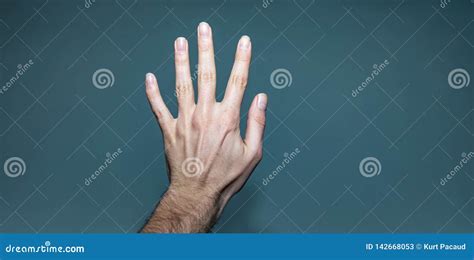 Left Hand With Broken Finger And Ganglion Cyst Stock Image Image Of