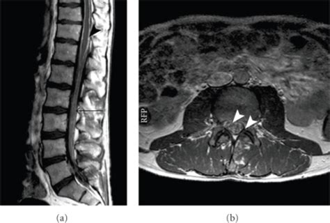 A Sagittal And B Transversal T1 Weighted Contrast E Open I