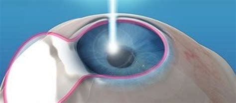 Refractive Surgeries Lasik Prk Smile Everything You Need To Know