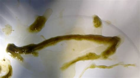 please identify these worms at ask humaworm parasites with image embedded topic 2113949