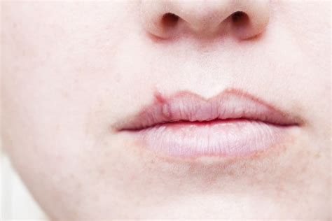 Cold Sore Vs Pimple On Lip How To Identify And Treat